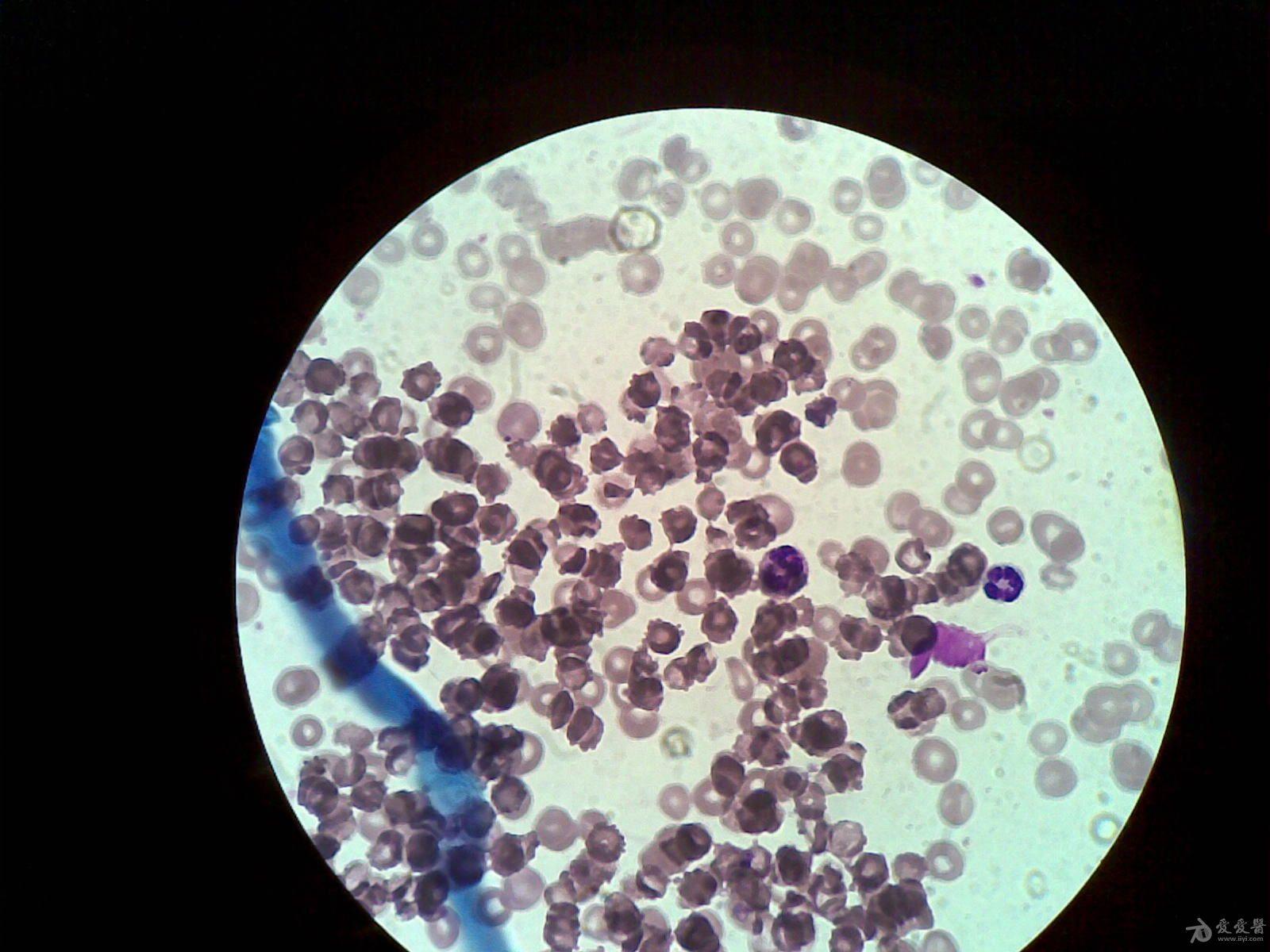 红细胞叠连图片