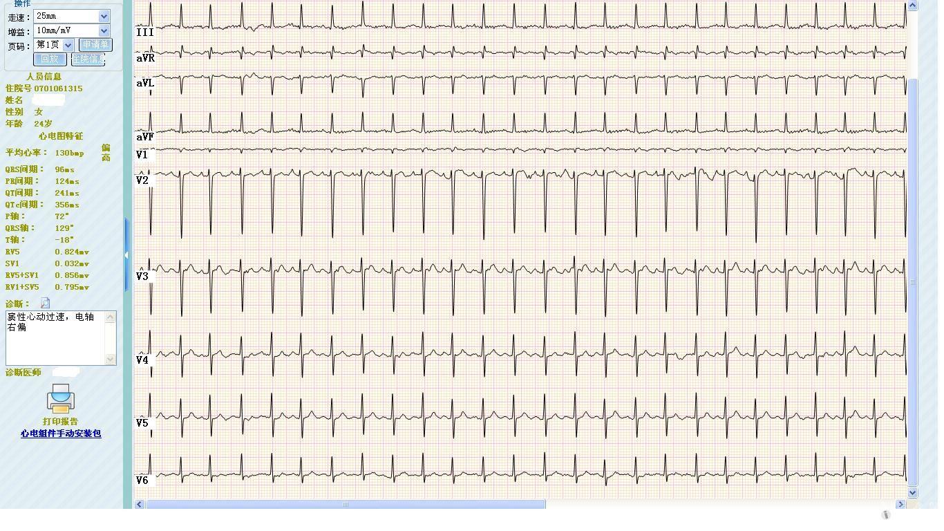 一个心肌炎患者的心电图