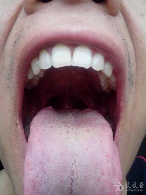舌头根部有大疙瘩图片