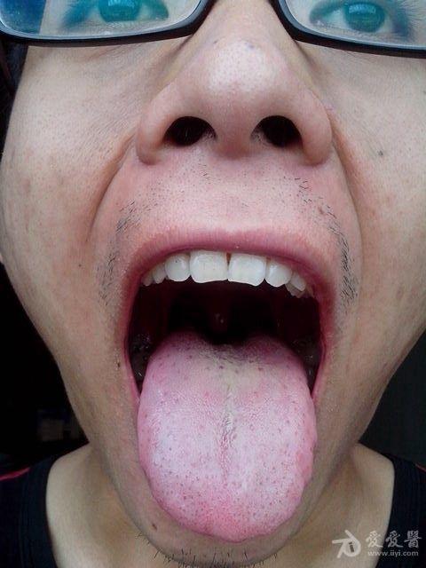 舌根淋巴组织增生图片图片