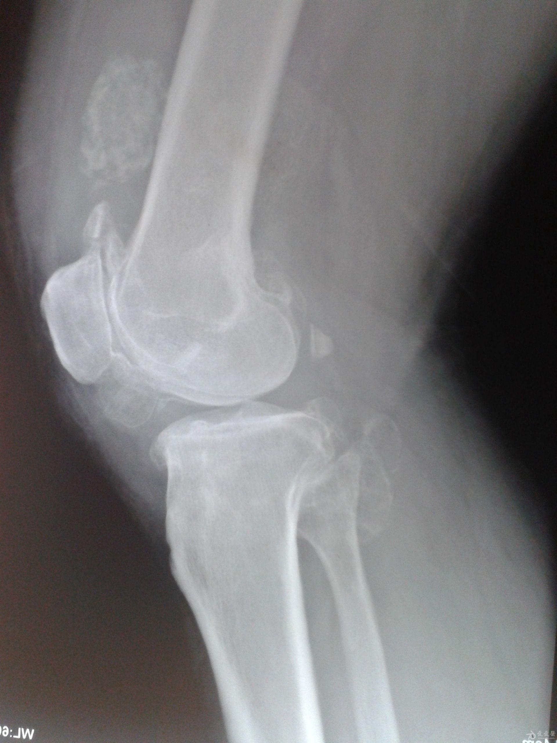 上传2位患者膝关节的dr片
