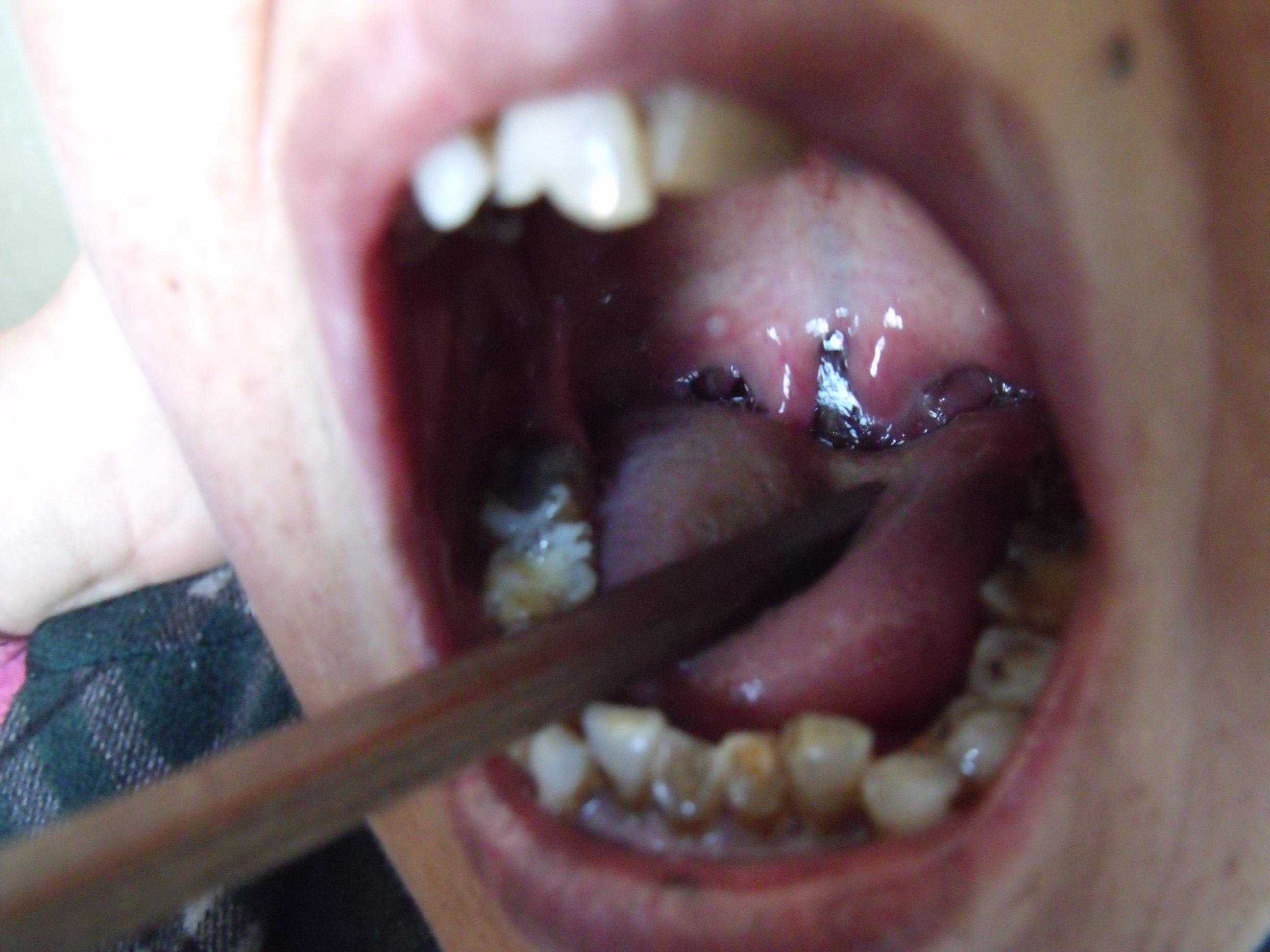 喉咙腭垂肿大图片