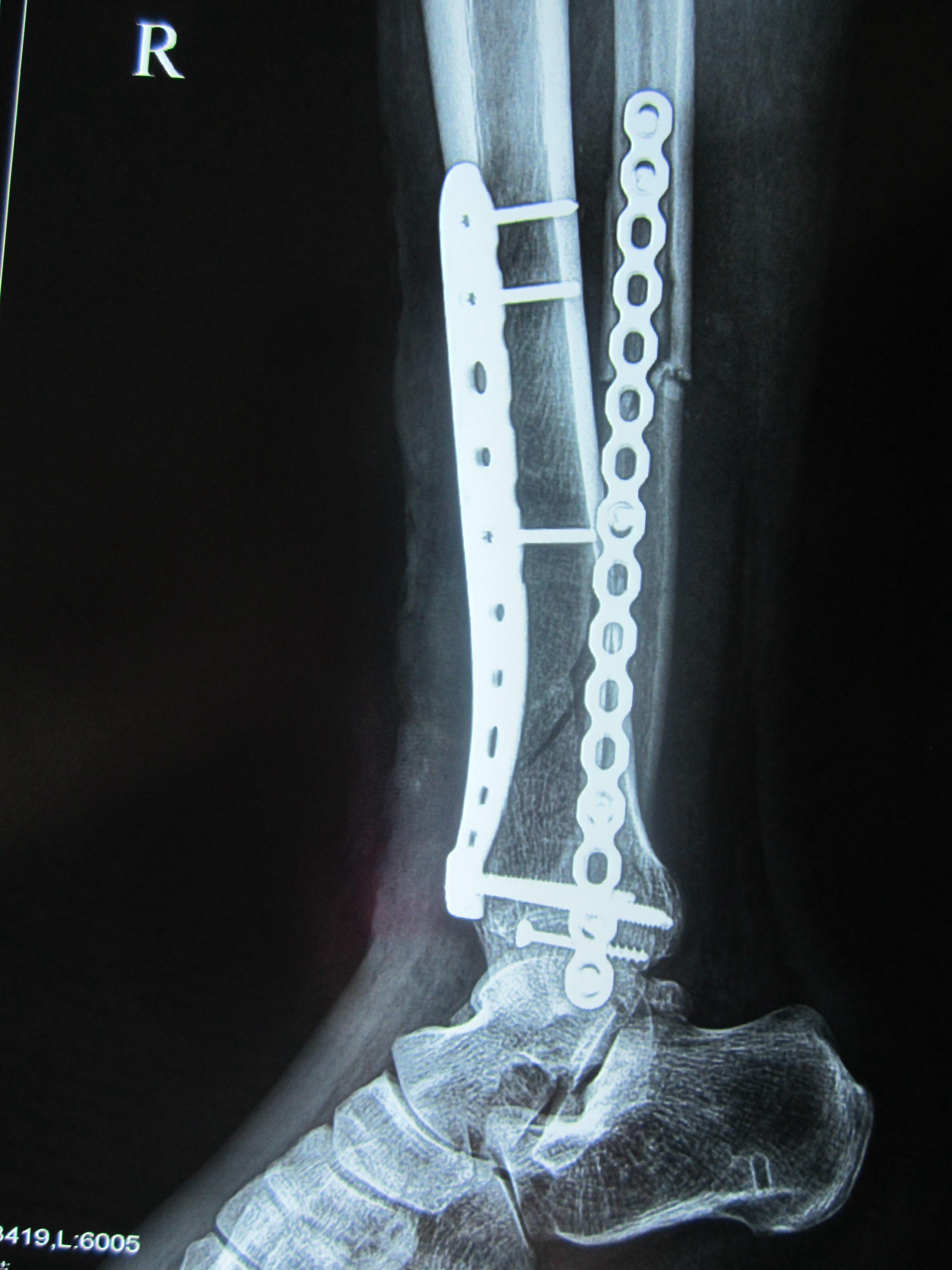 小腿胫骨螺旋骨折图片图片
