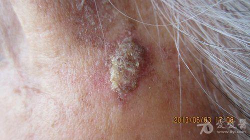 老年女性患者脸部皮损