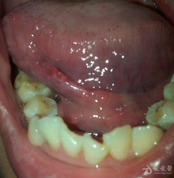 口腔感染hpv图片 表现图片