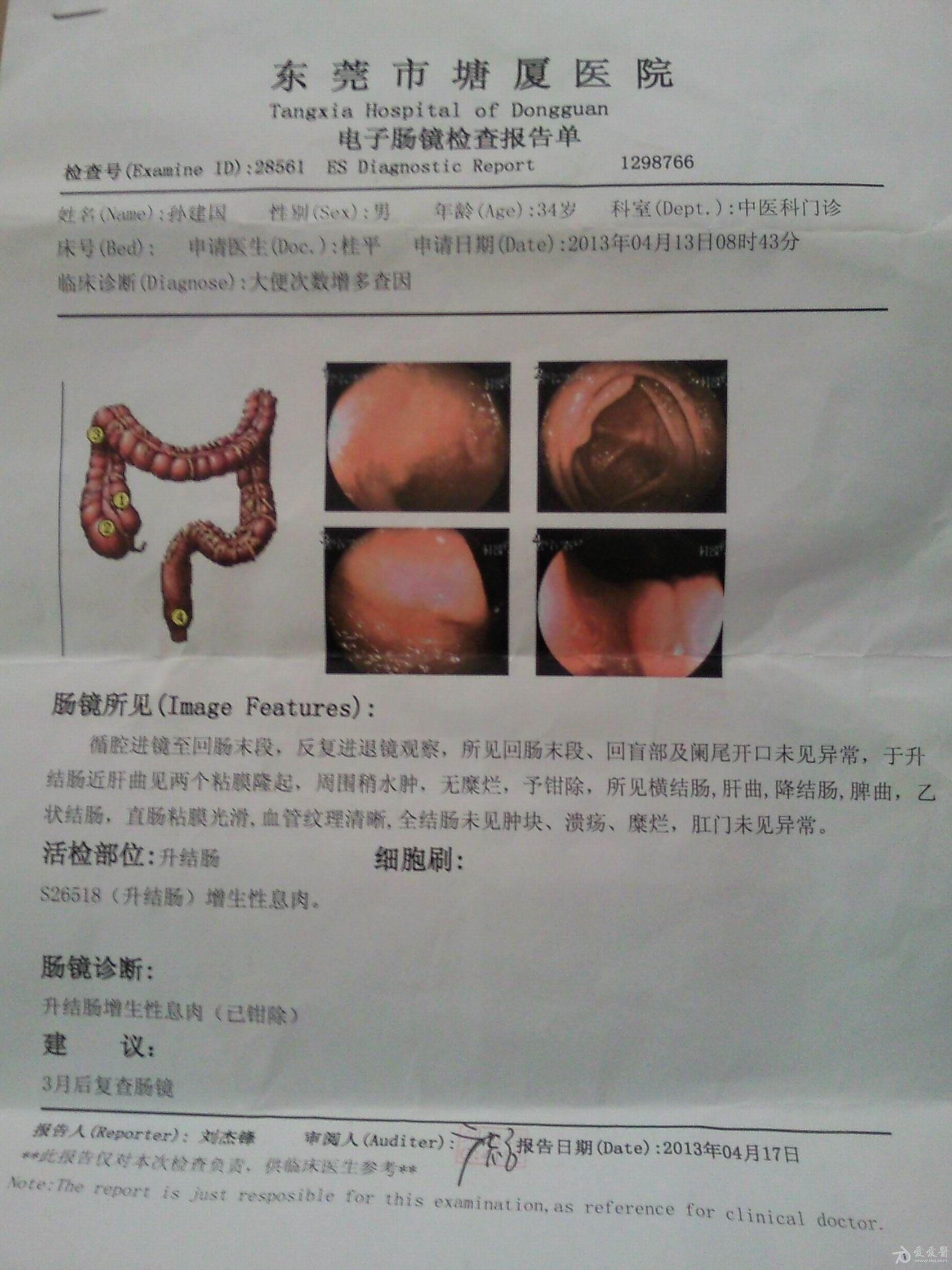 肠结核肠镜图片