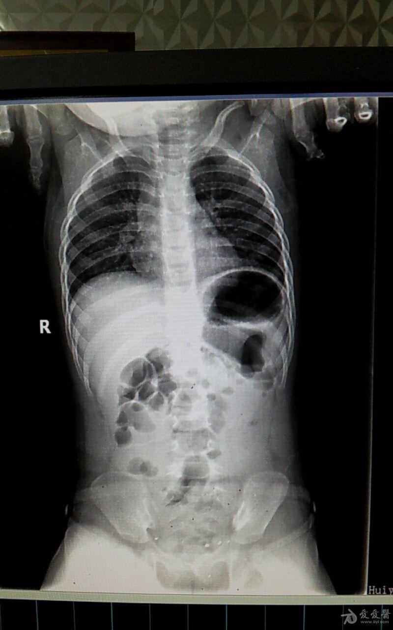 上腹部CT平扫图片