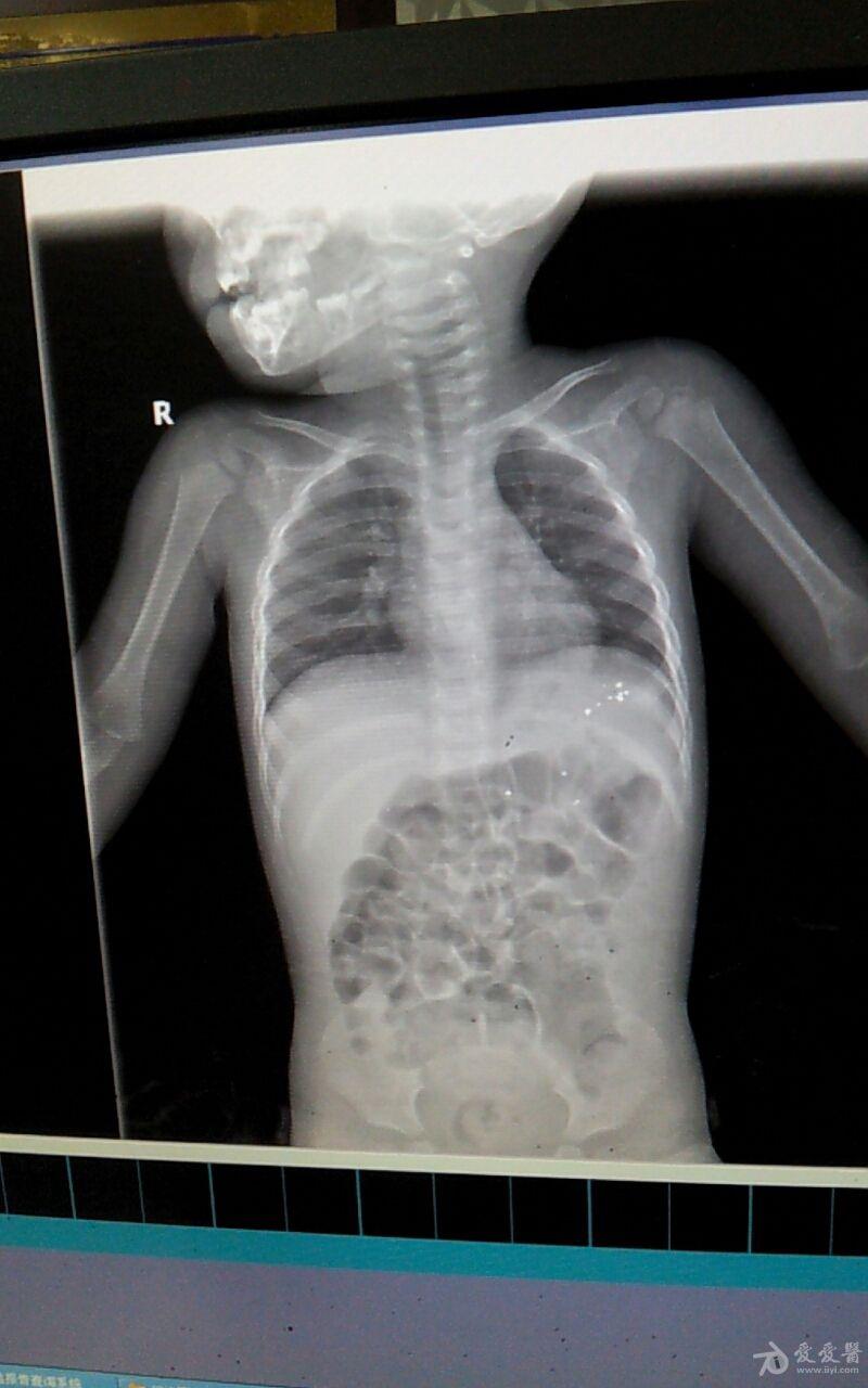 误服水银(处理见14楼)