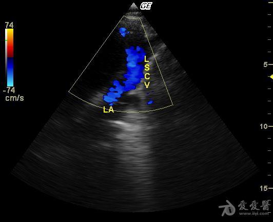 永存左上腔静脉 超声医学讨论版 爱爱医医学论坛 爱爱医医学网