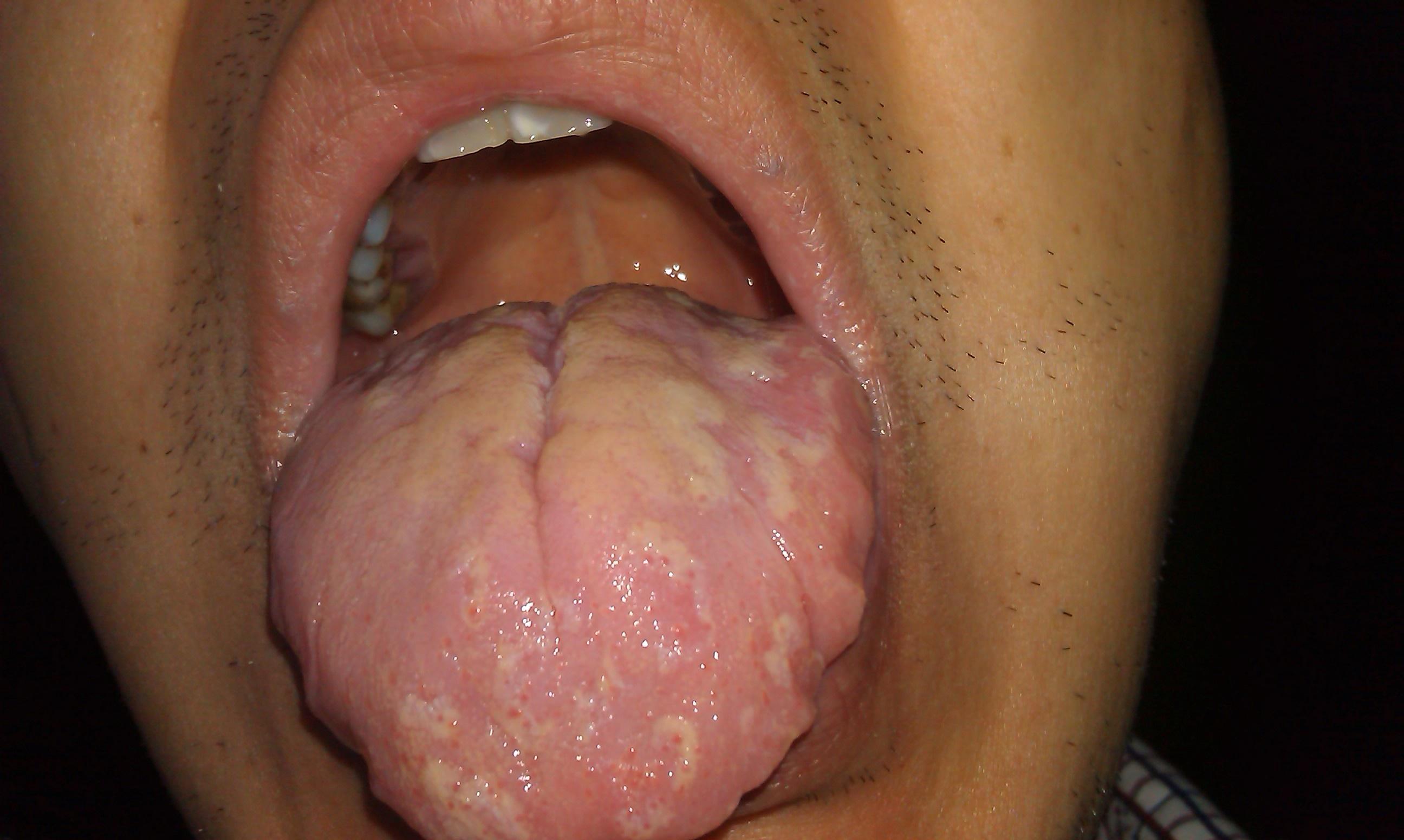 舌裂口水多脉弱易汗杂症请老中医出招