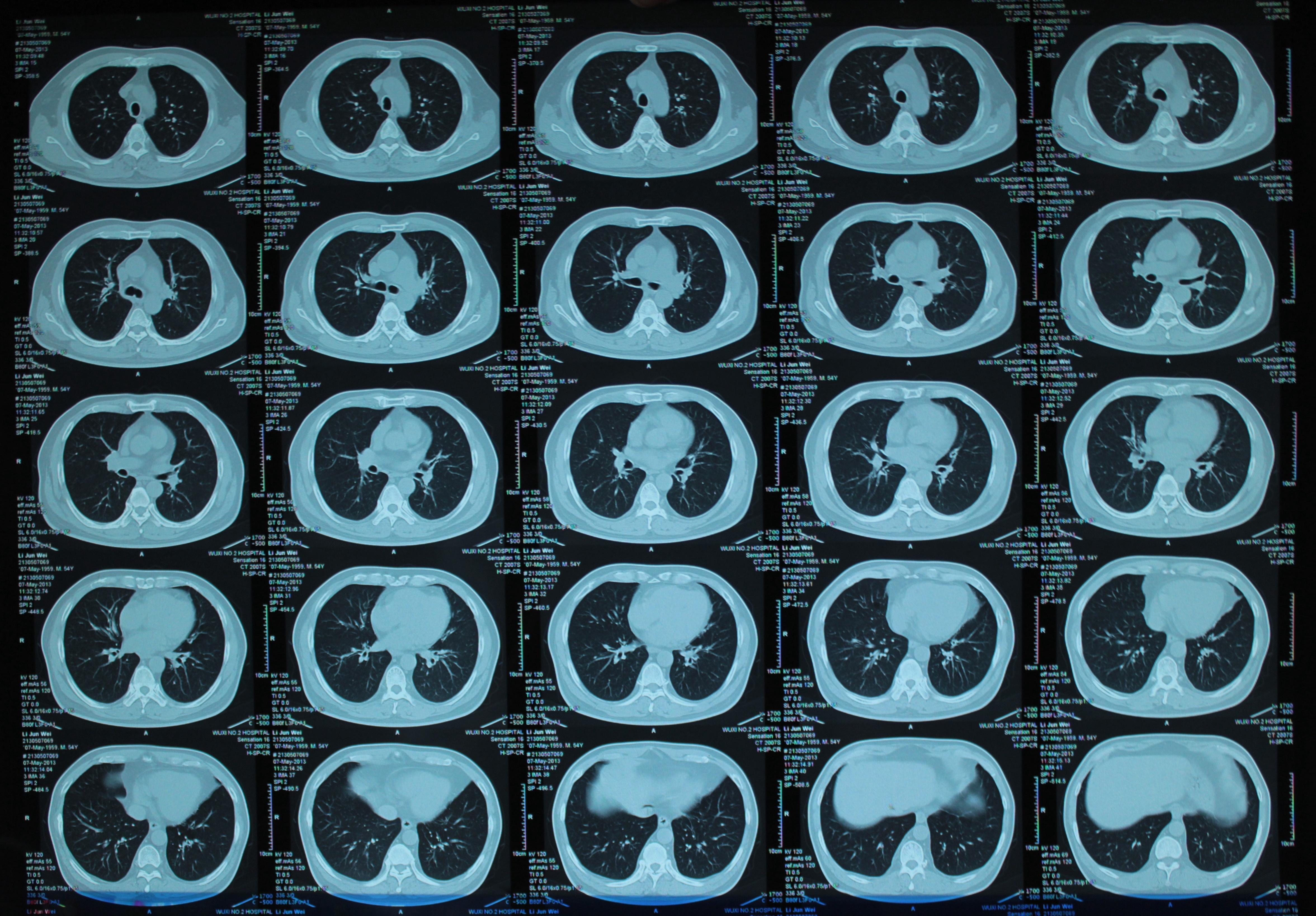肺结核CT片图片