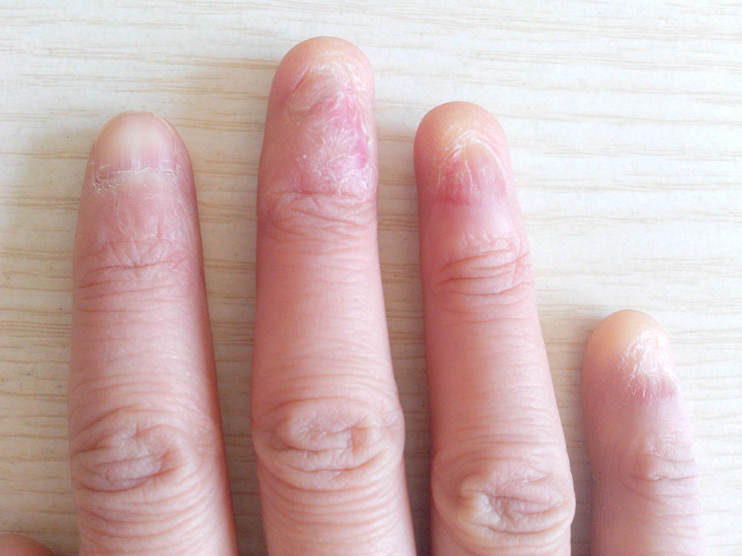 扁平苔癣指甲初发图片图片