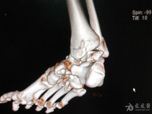 距骨粉碎性骨折