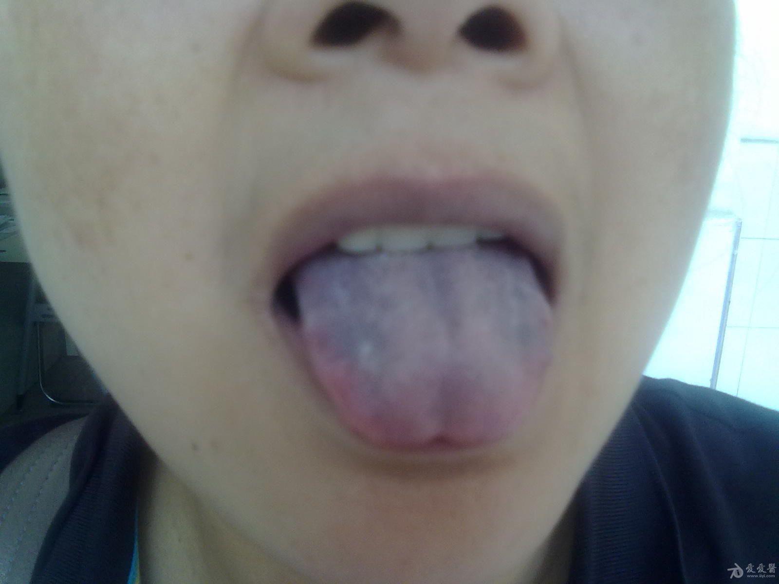 舌质紫暗,求会诊
