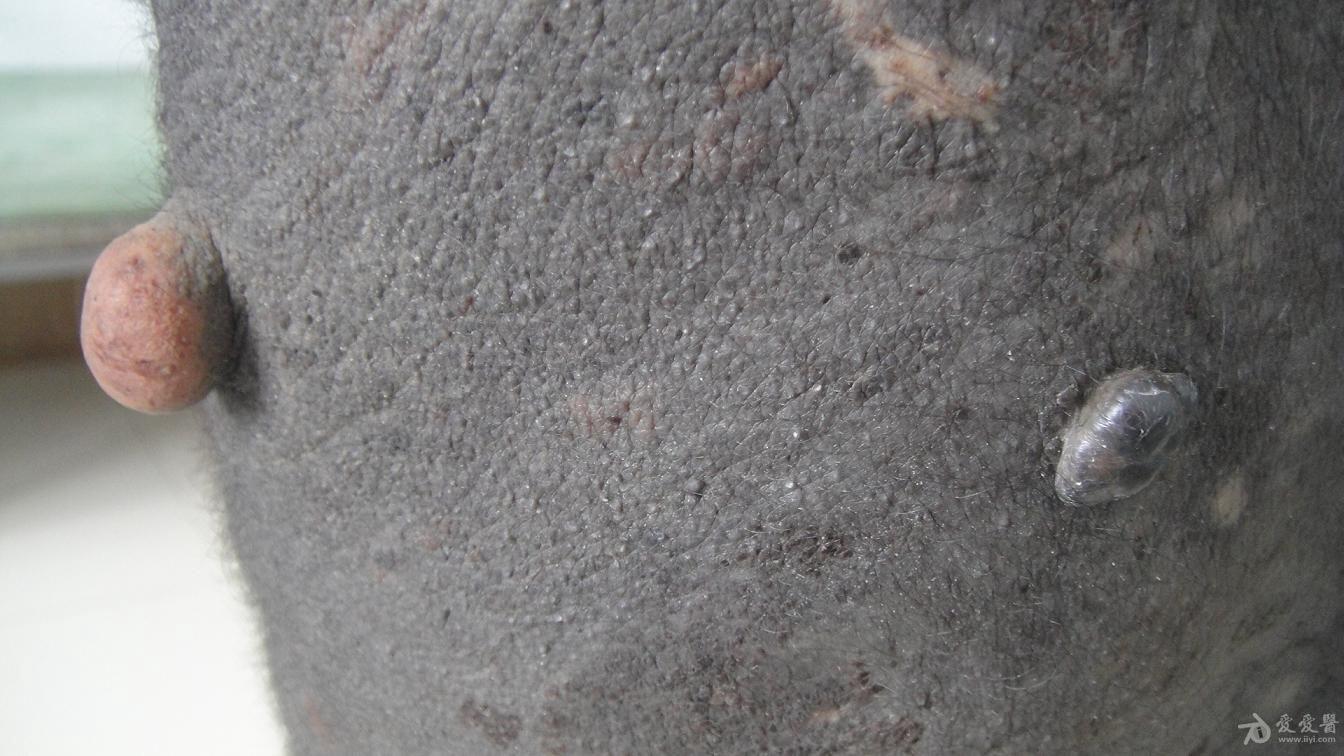 经典病例 兽皮痣