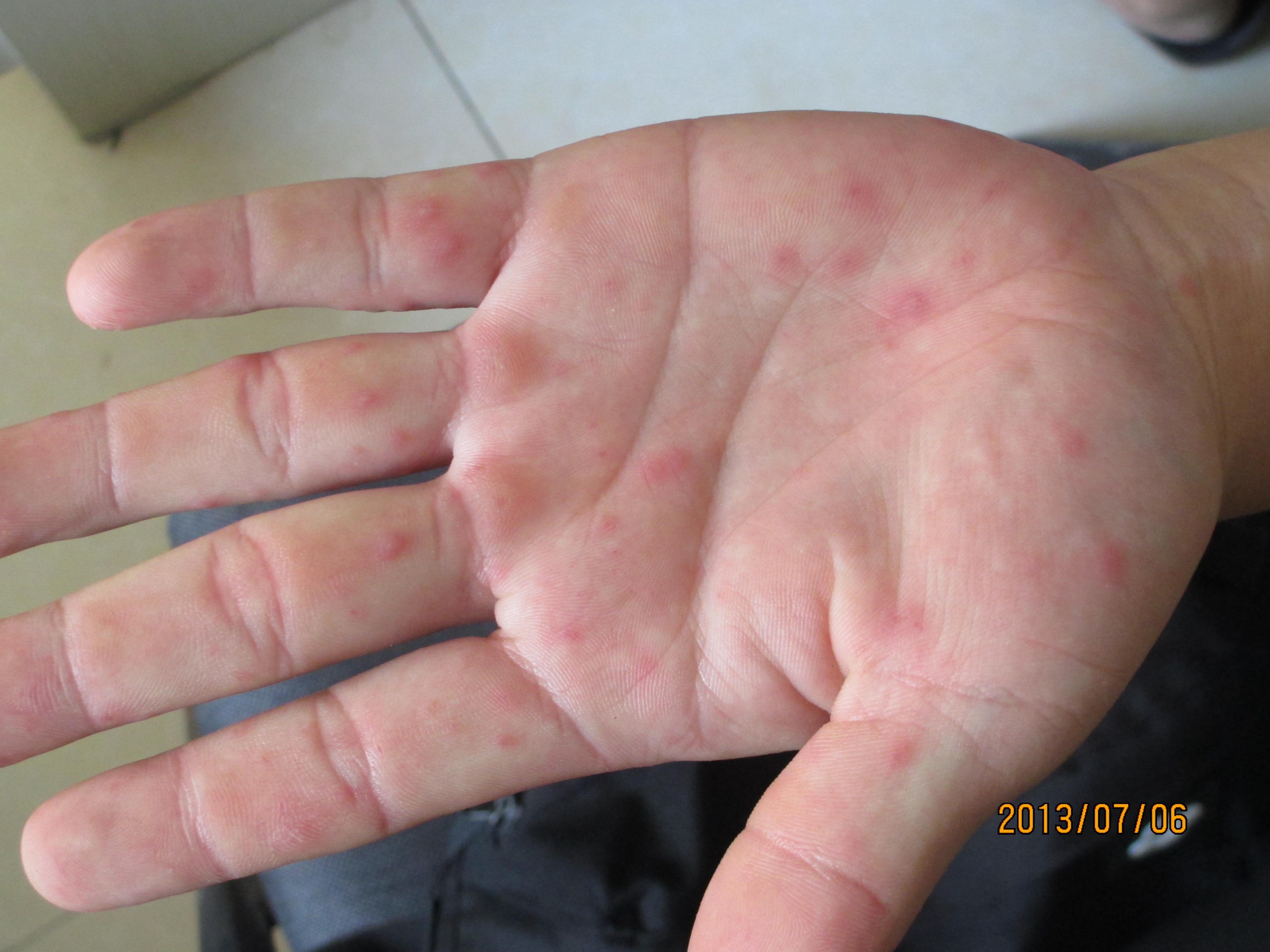 发现一例成人手足口,大家给鉴定下