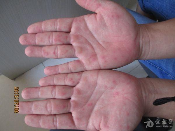 发现一例成人手足口,大家给鉴定下