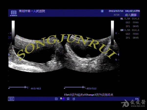 膀胱长息肉的彩超图片图片