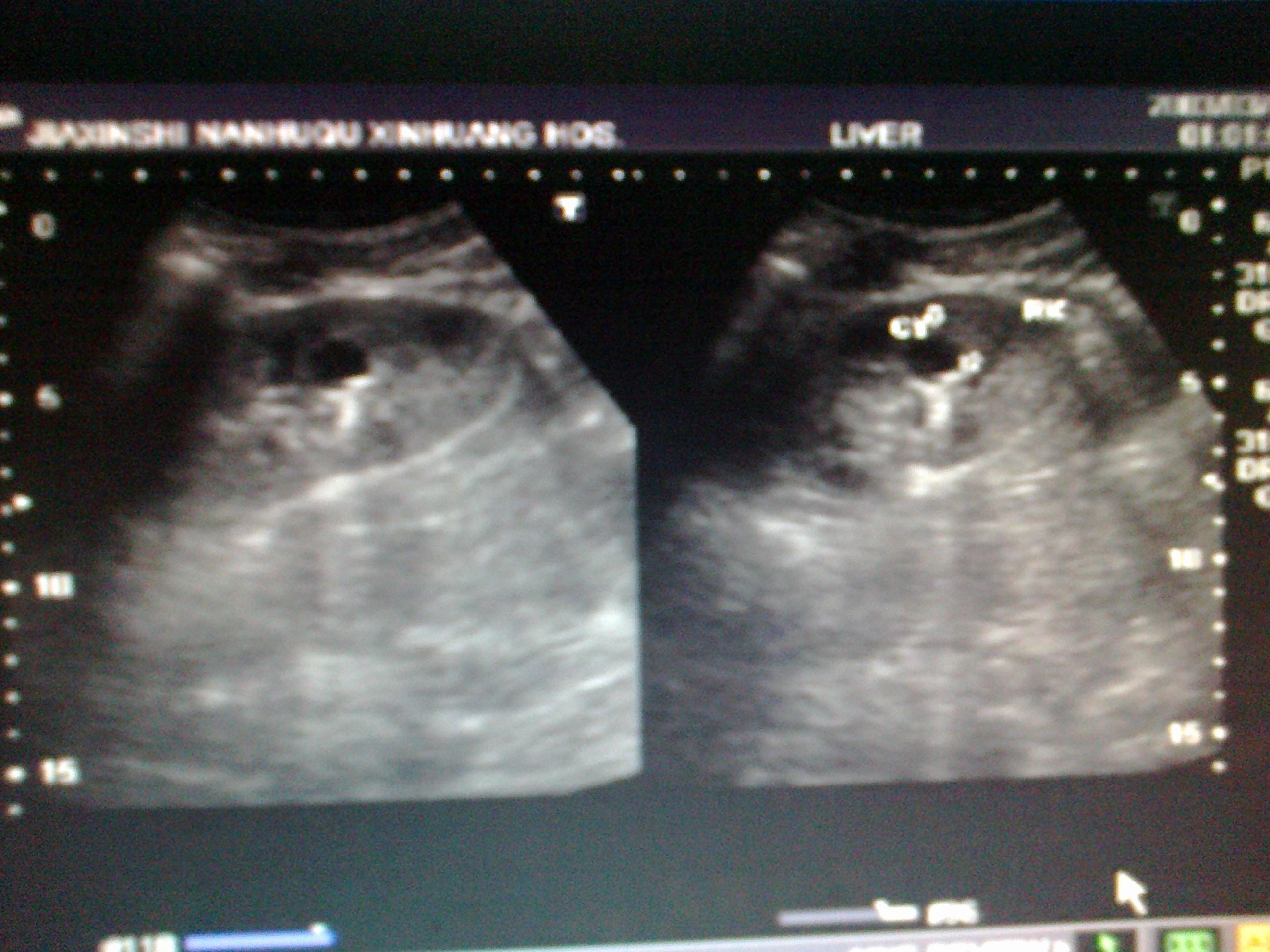 左肾钙乳症图片