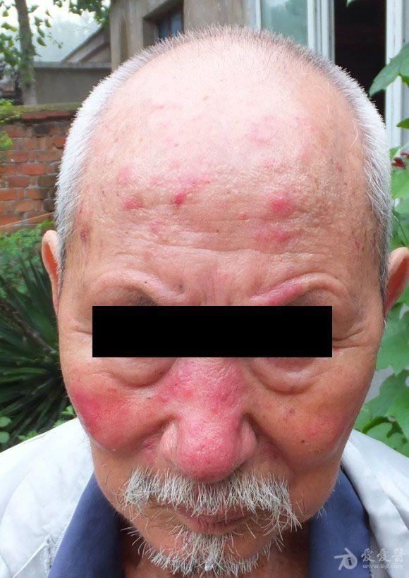 酒糟鼻伴激素依赖性皮炎,还是dle啊