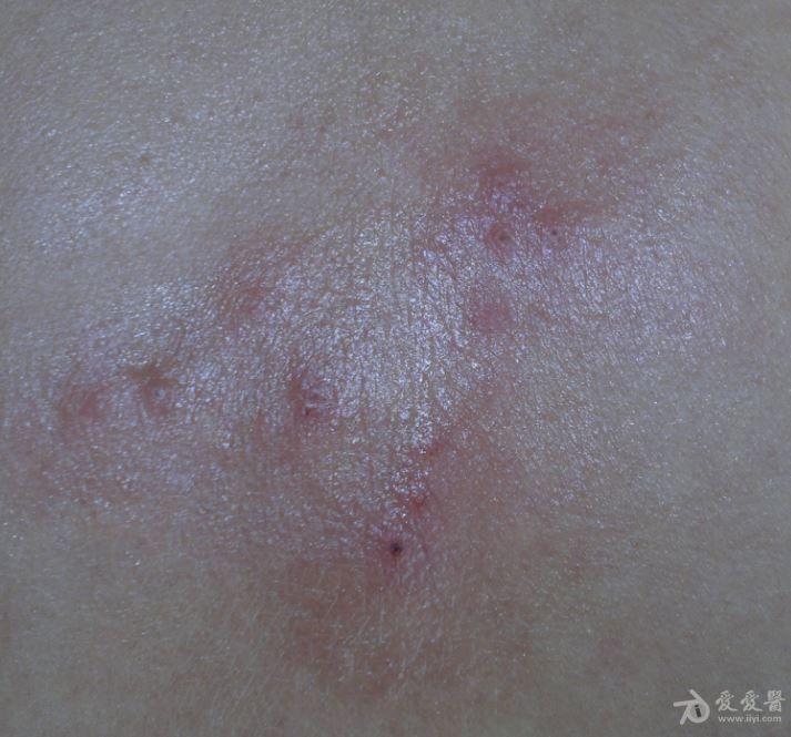 下背部疖肿?双腋下淋巴结肿痛.