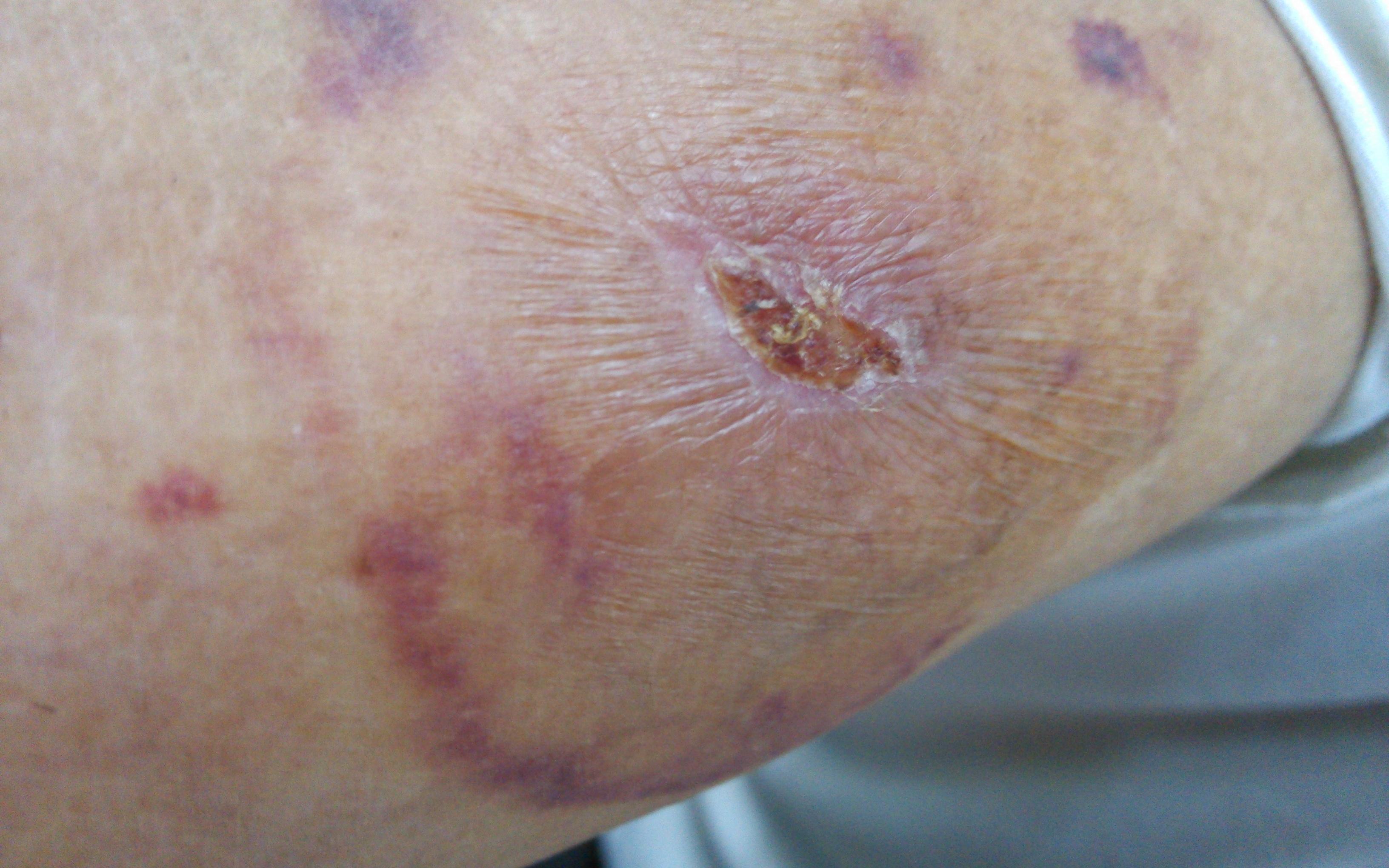 癌症晚期皮下出血图片图片