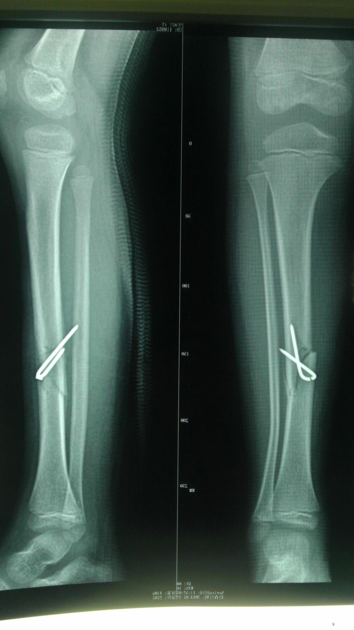 腓骨青枝骨折或无明显的骨折线但有异常弯曲者称之为腓骨的可塑性畸形