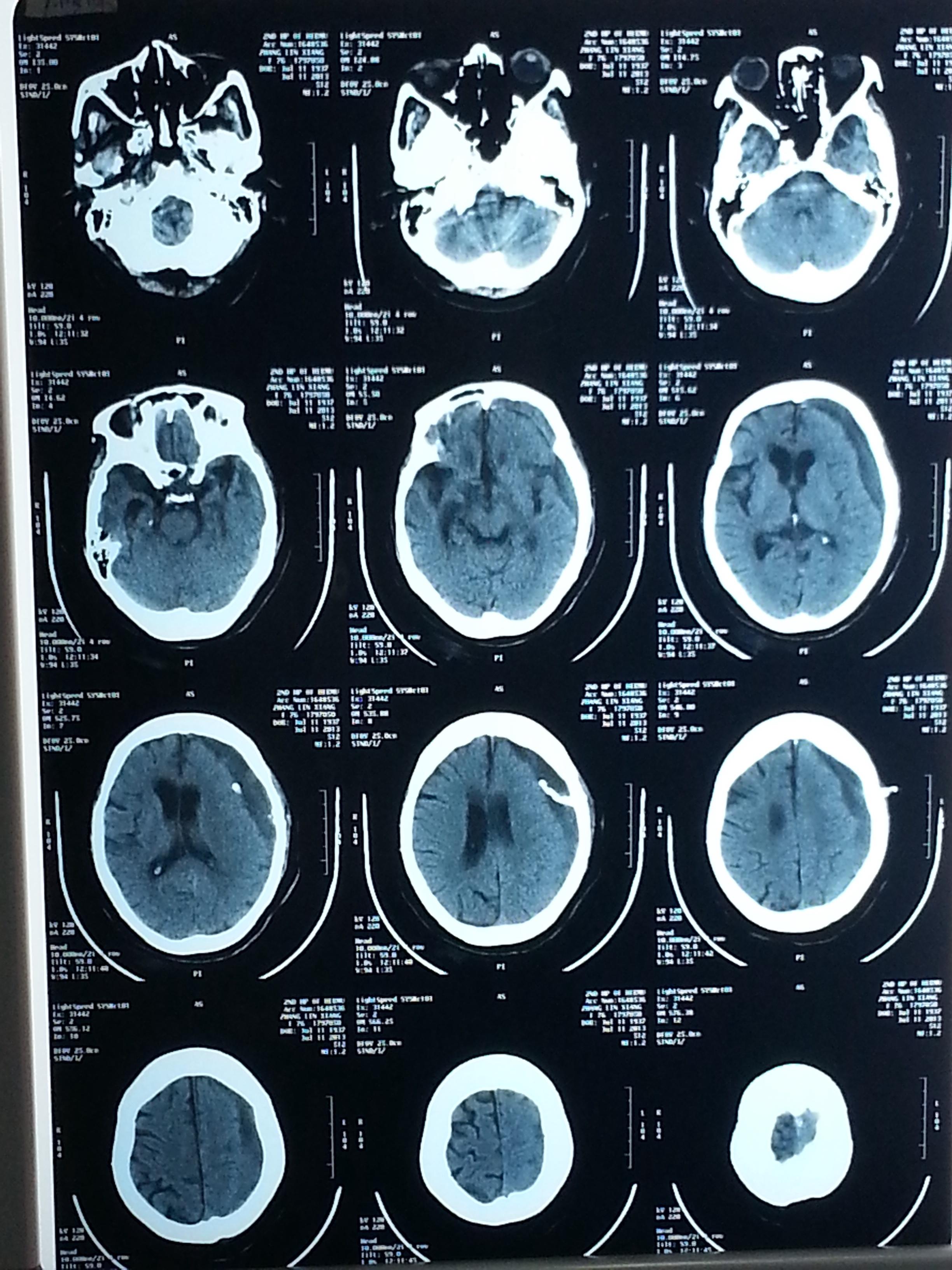 慢性硬膜下血肿