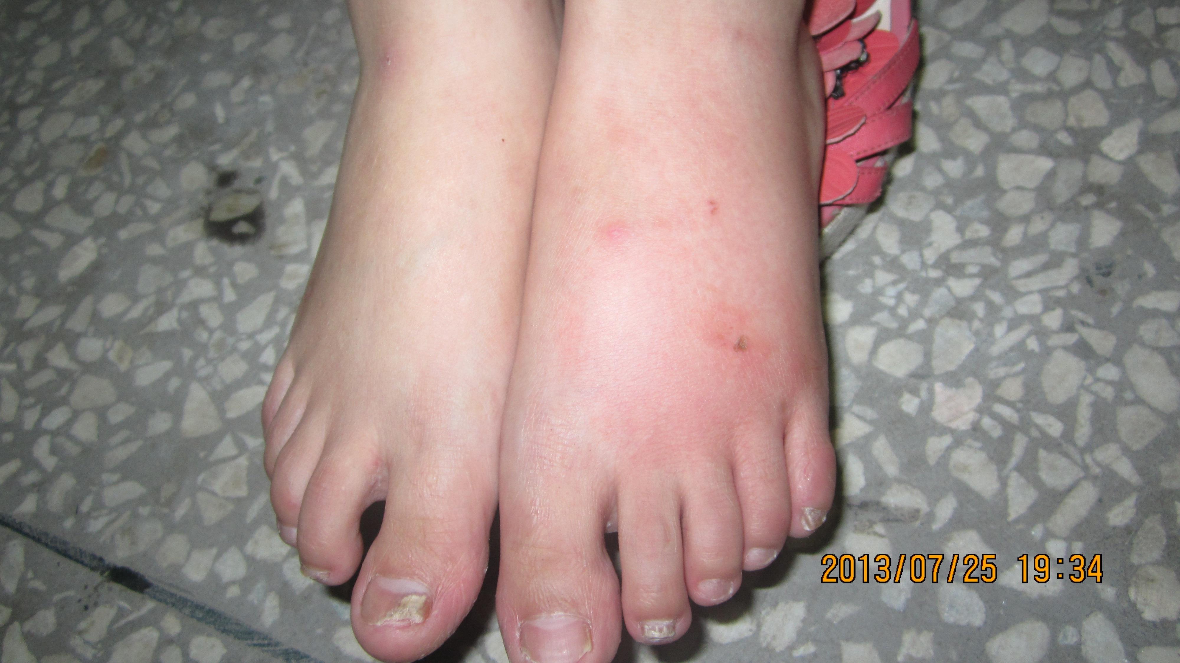 因左侧足背痛痒3天来诊,左侧足背红肿,局部皮温升高,无发热,畏寒尬 