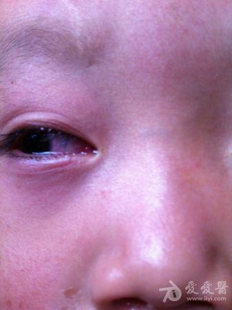 于四天前无明显诱因下出现右眼睑红肿,结膜充血,畏光,稍疼痛