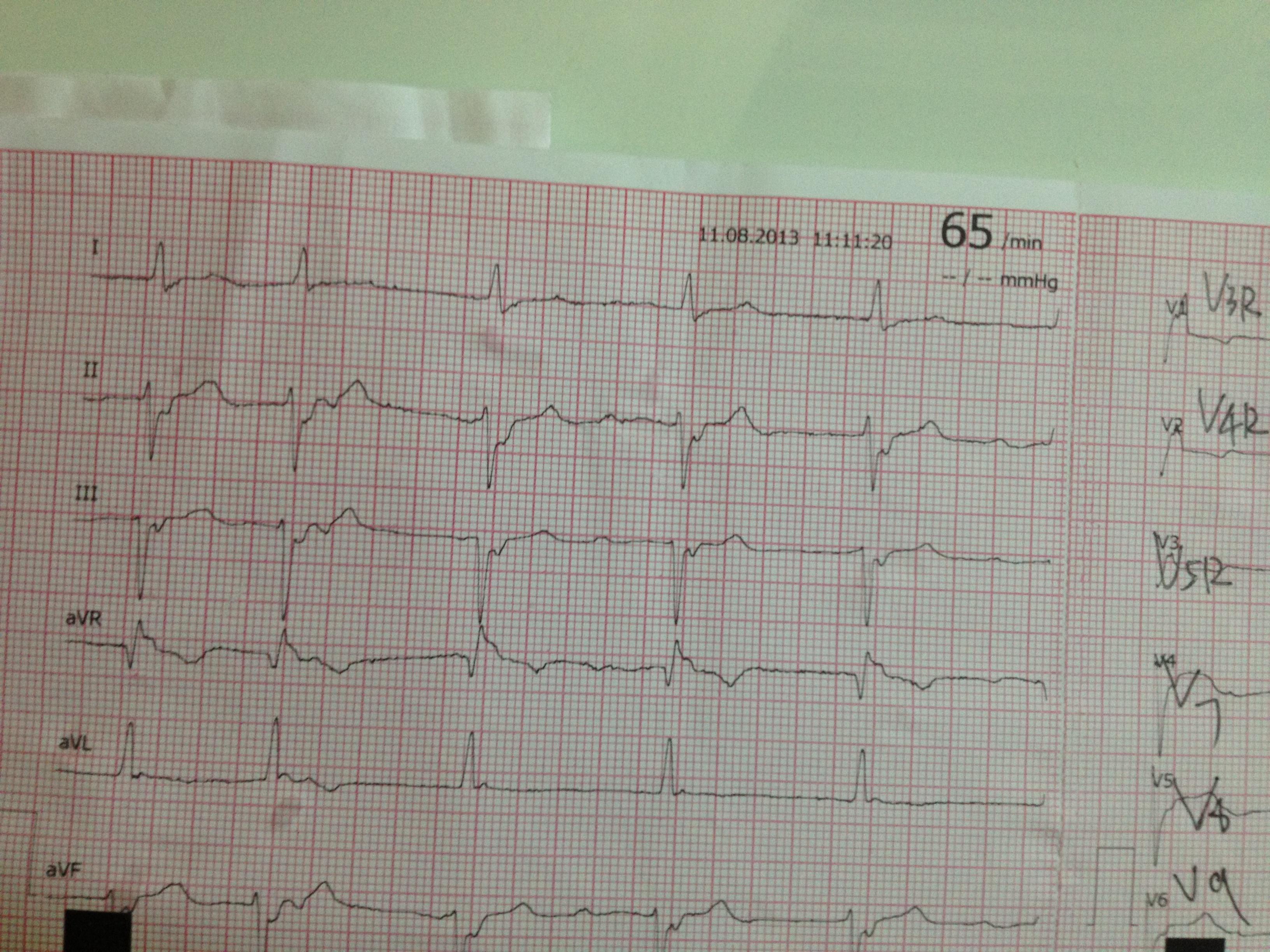 大家幫我看哈,這是同一個病人做的兩次心電圖
