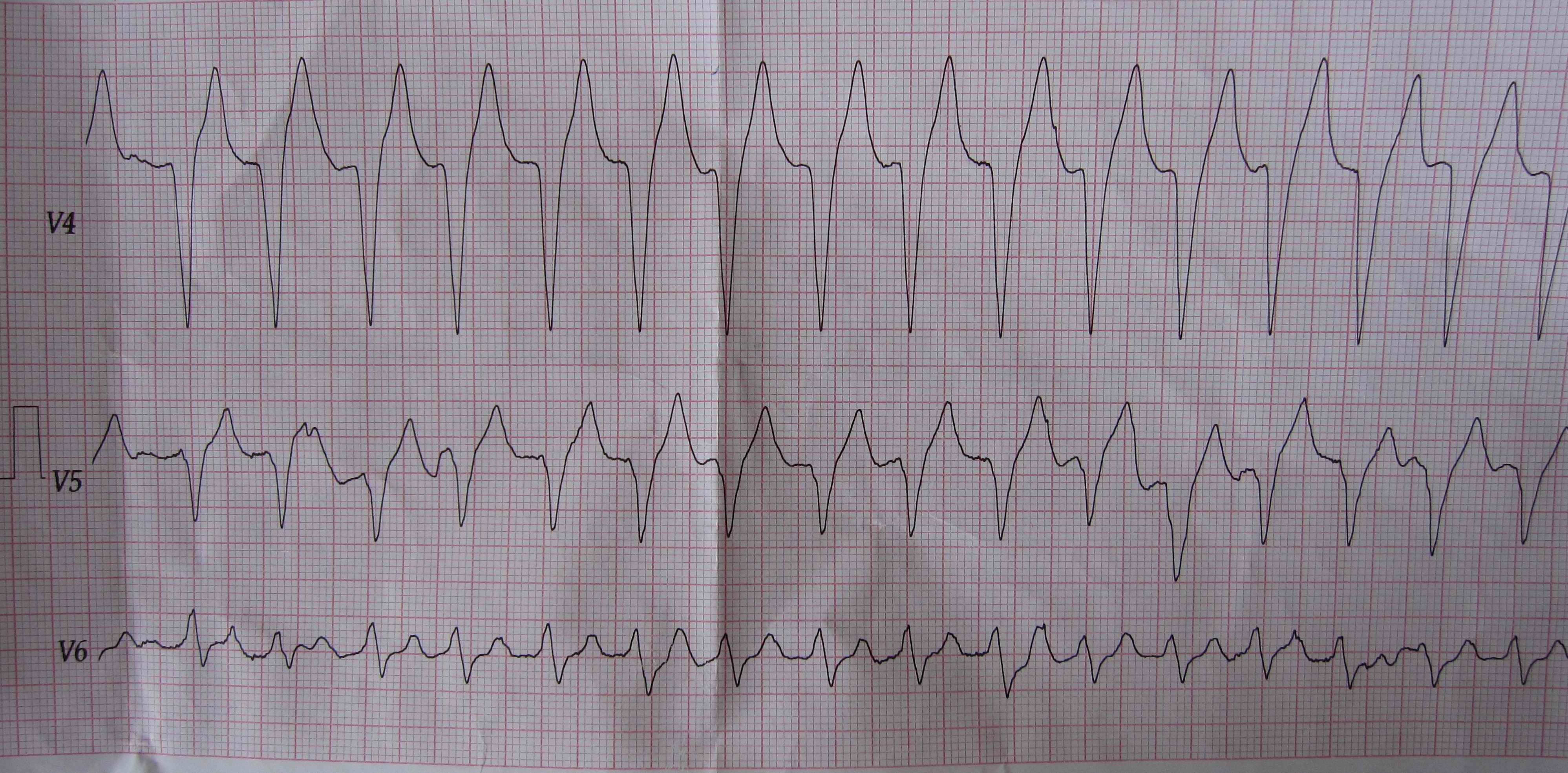 肺源性心脏病人的心电图,病人已抢救无效