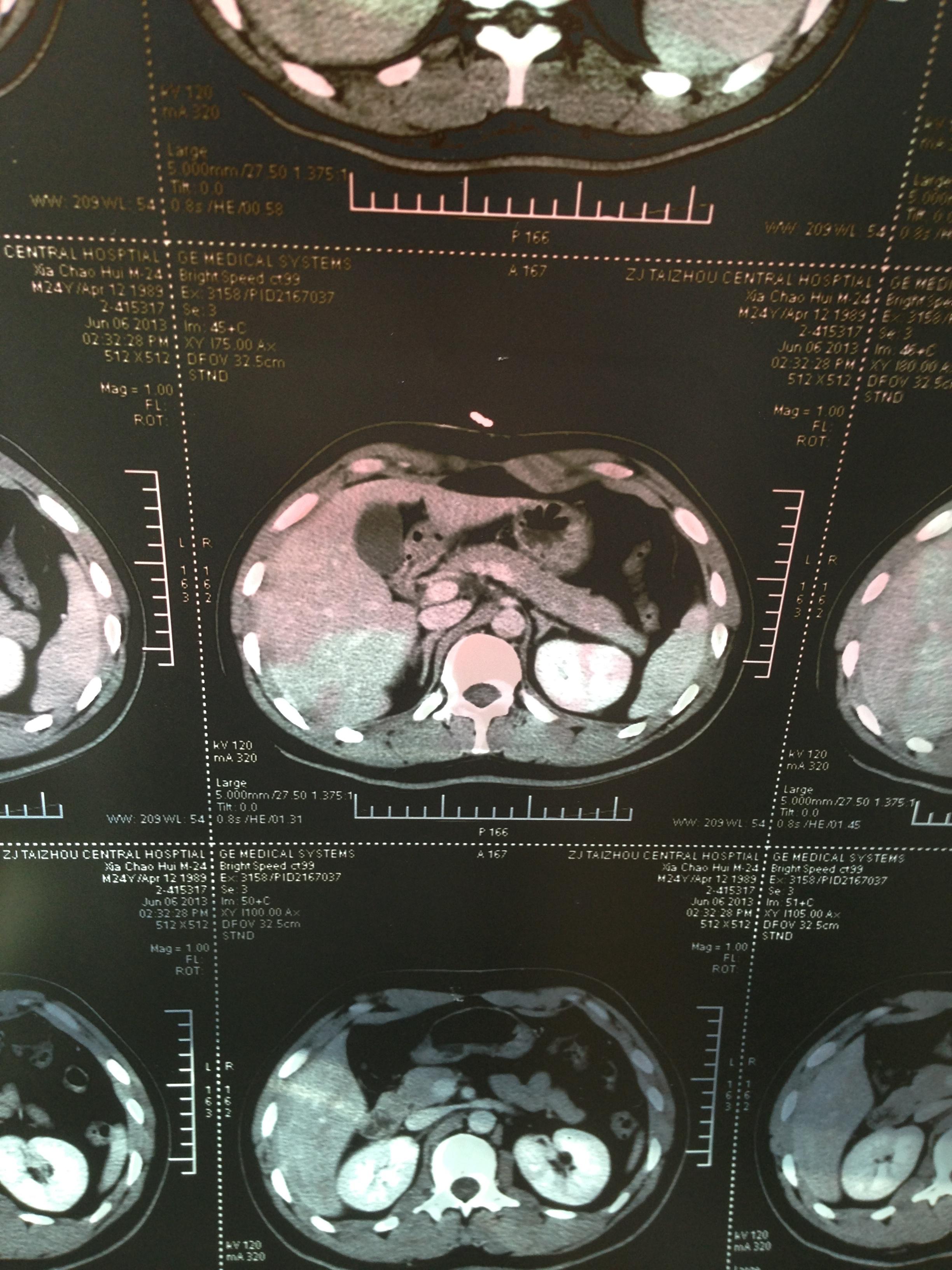 所以b超检查了肾脏 发现偏强回声区11*8mm 无明显血流信号 考虑错构瘤