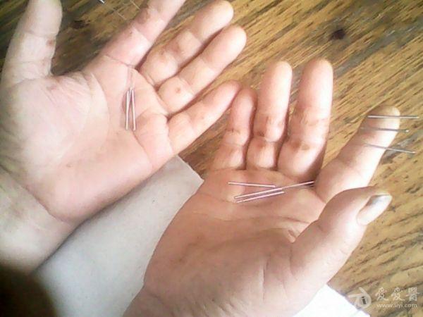 董氏奇穴治疗手掌干裂 脱皮 十年病史 有图 大家探讨下 - 中医针推外