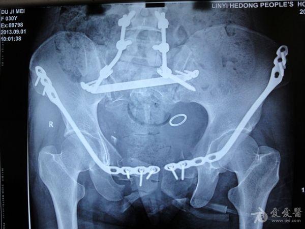 骨盆c3骨折微创治疗