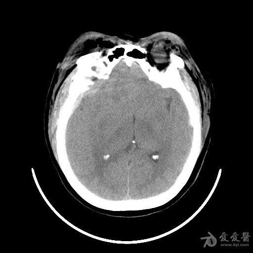 颞窝硬膜外血肿,开不开?何时开?