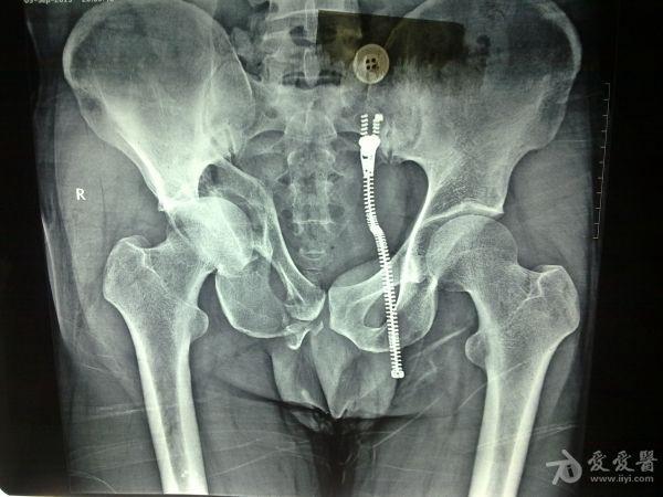 x线片示右髋臼骨折耻骨下支骨折请教具体治疗方法