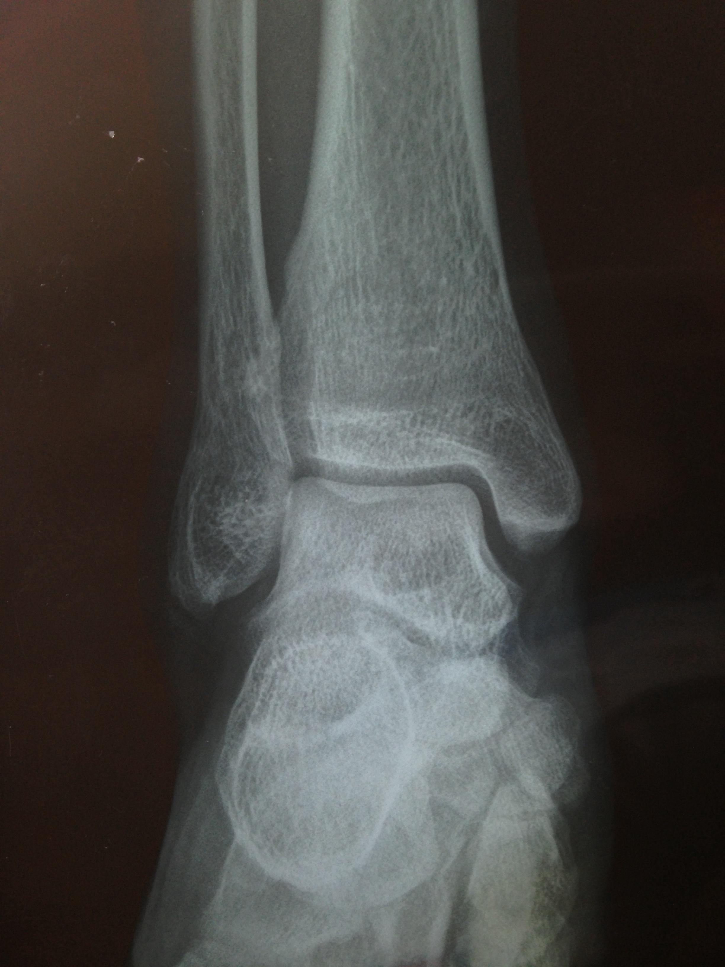 撕脱的骨片在侧位哪里?