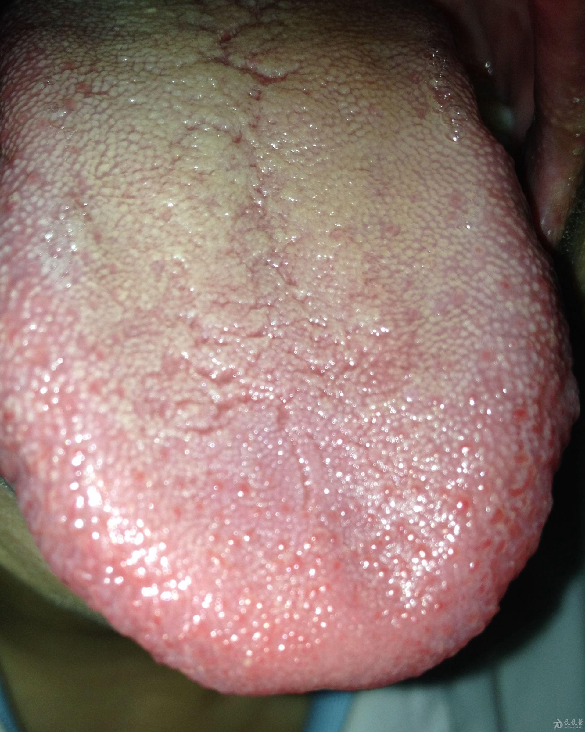 湿热的舌苔是什么样子图片