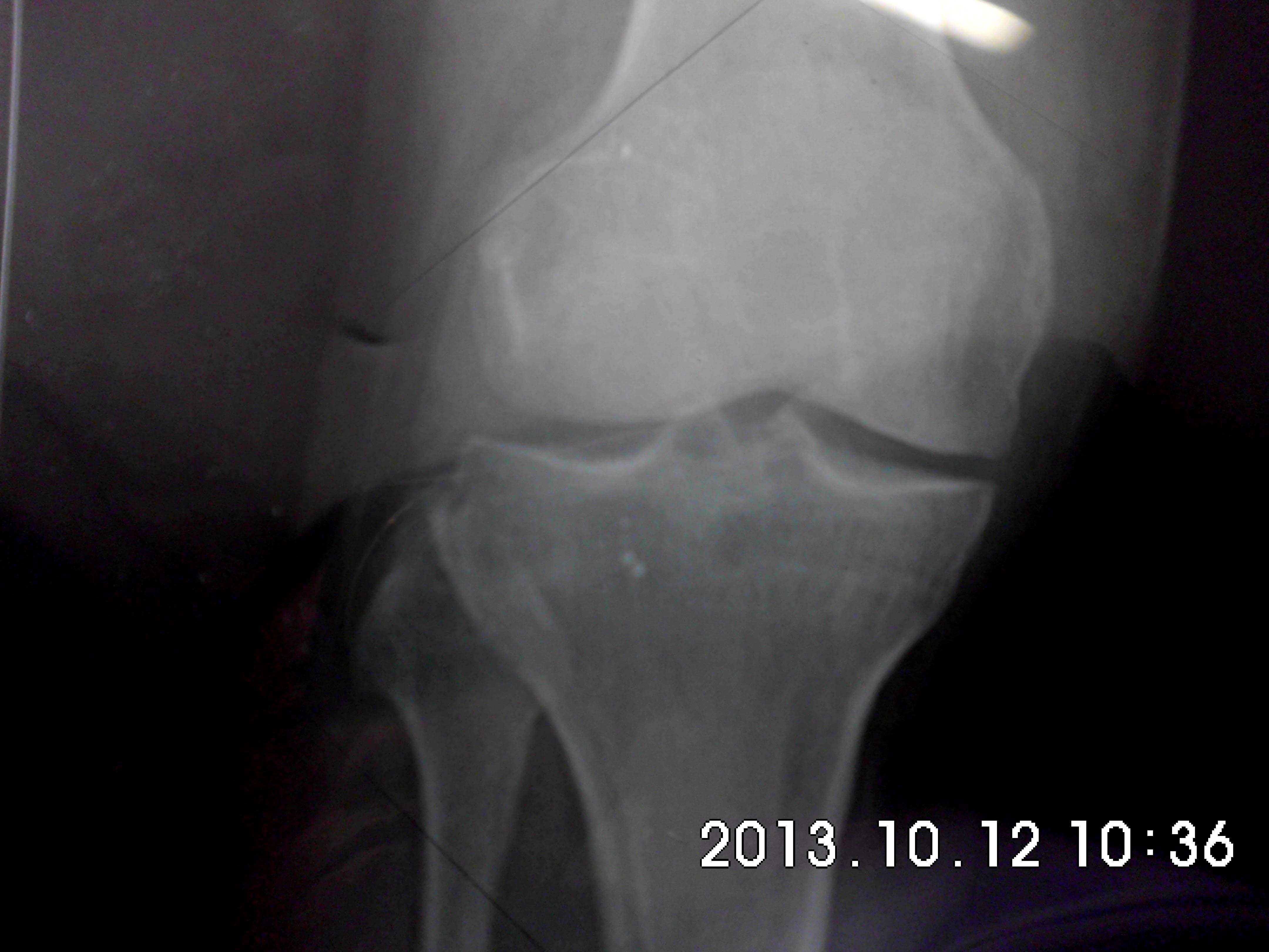 超声入门贴174-----膝关节髌上囊滑囊炎