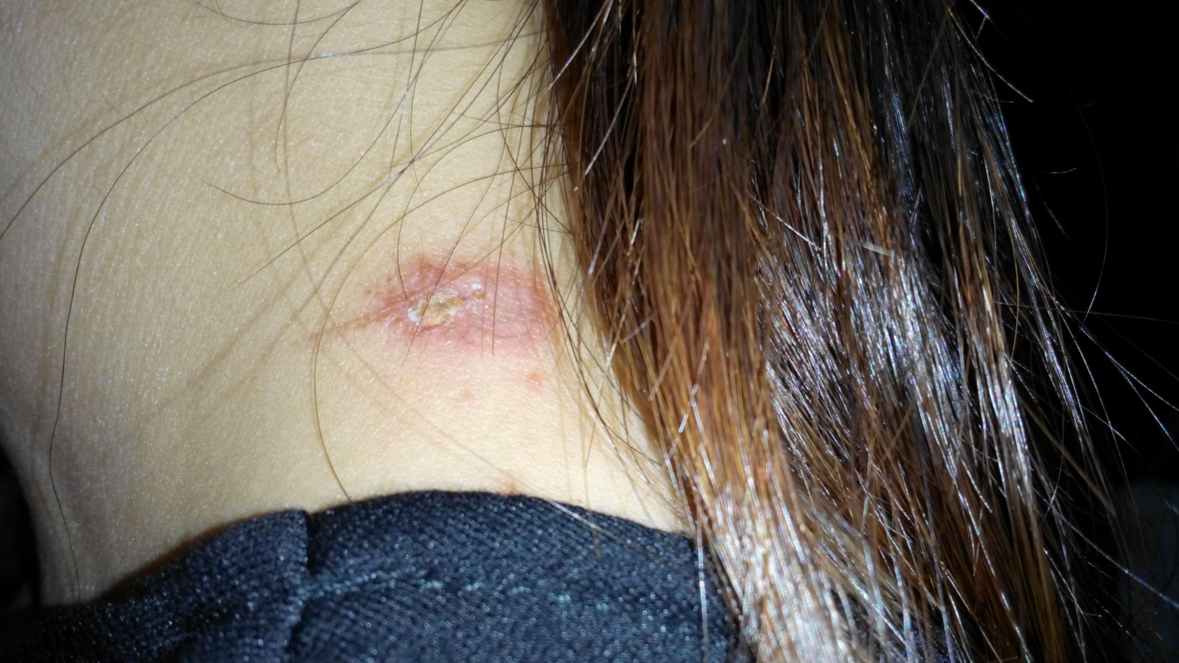 (水肿性红斑,脓疱,伴刺痛可以诊断:隐翅虫皮炎