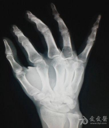 手指病理性骨折.