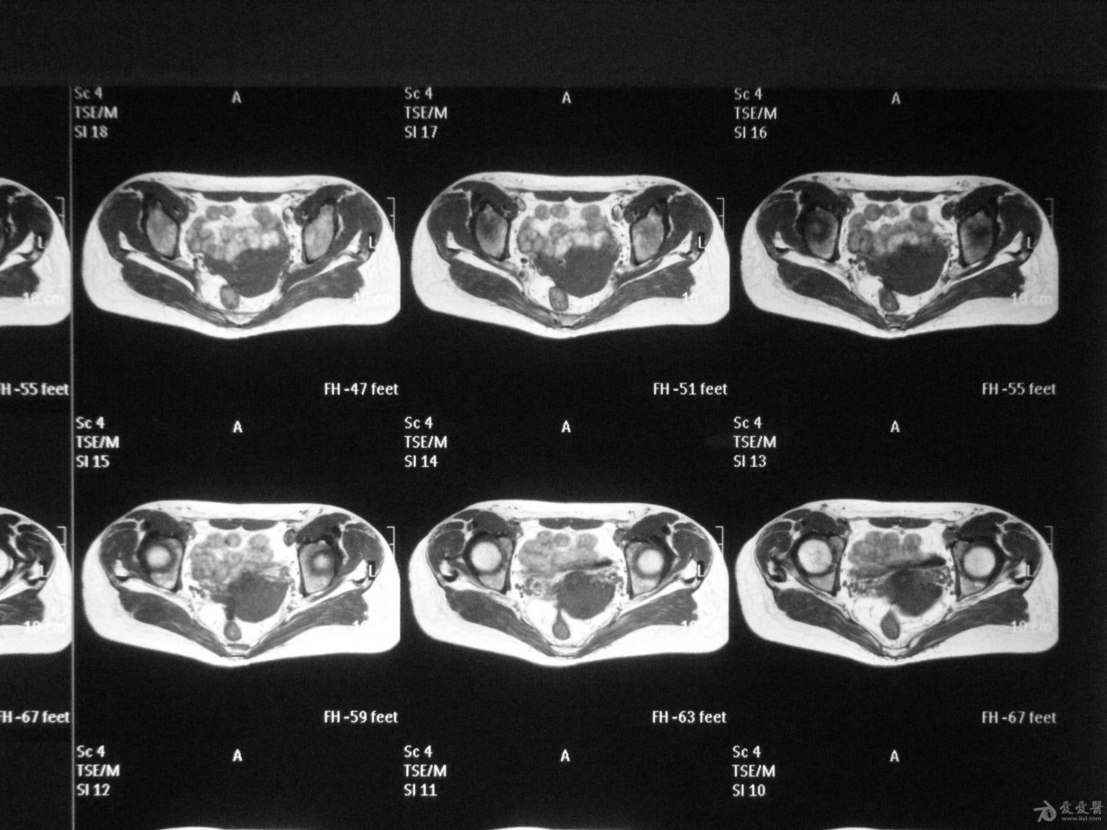 髋关节mri