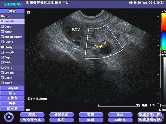 超声所见:子宫稍大,宫内可见一小囊(假孕囊),右侧输卵管见明显孕囊,囊