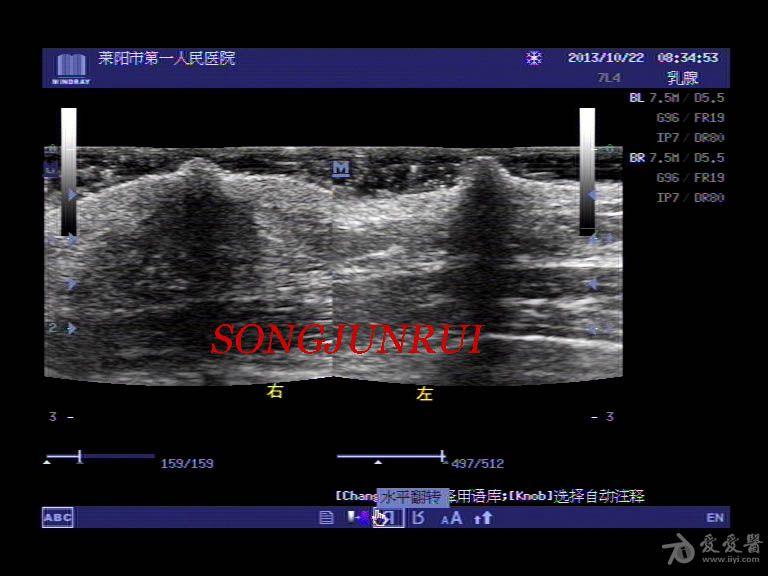 男性乳腺发育超声图片