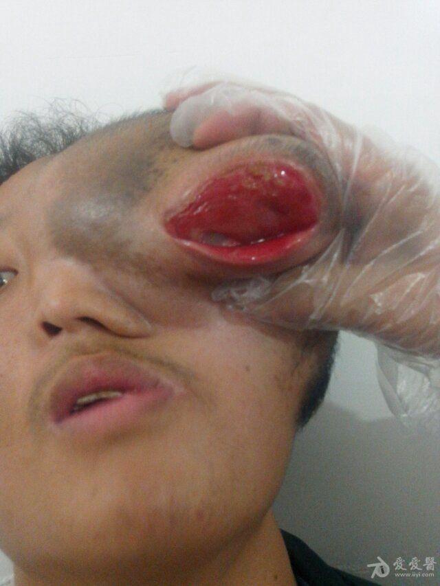 医学罕见的眼部肿瘤?