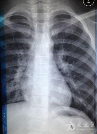 昨天也就是10月27日到医院复查,拍的片子如下,下的结论是还有少量肺炎