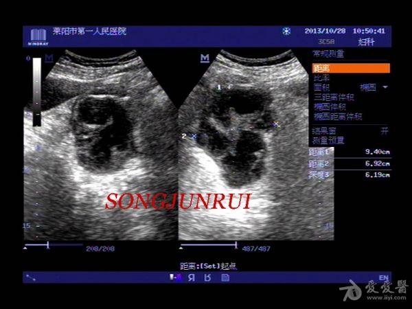 超声入门贴193-----输卵管积脓