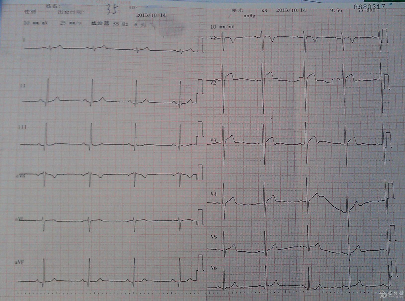 疑似brugada 综合症,请山羊老师及各位老师分析 - 心电图脑电图专业