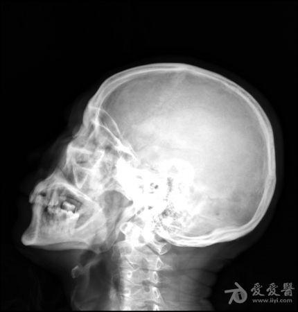 鼻骨骨折图片 x线图片